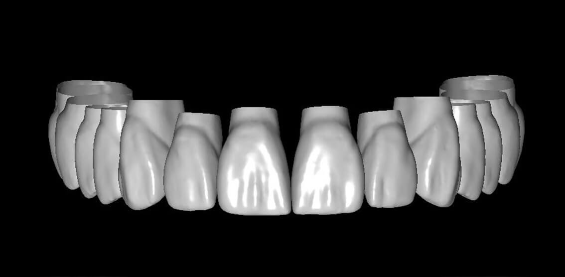 MOD exocad Scoop Library