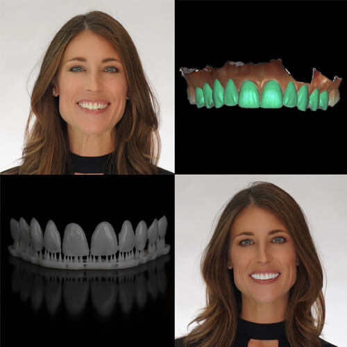 3D Printed Smile Designs and Veneers 1