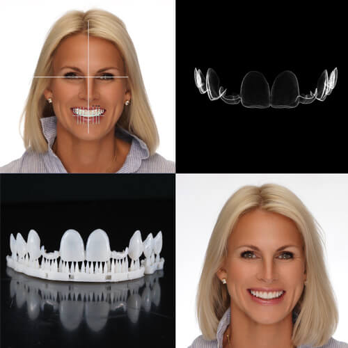 3D Printed Smile Designs and Veneers 4