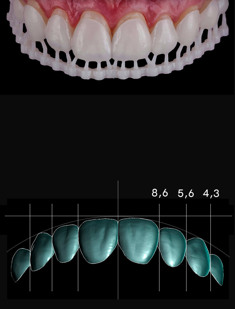 3D Printed Veneers CE Course