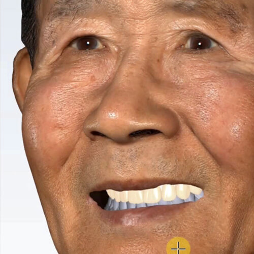 Full Mouth Reconstruction and Removables CE 4