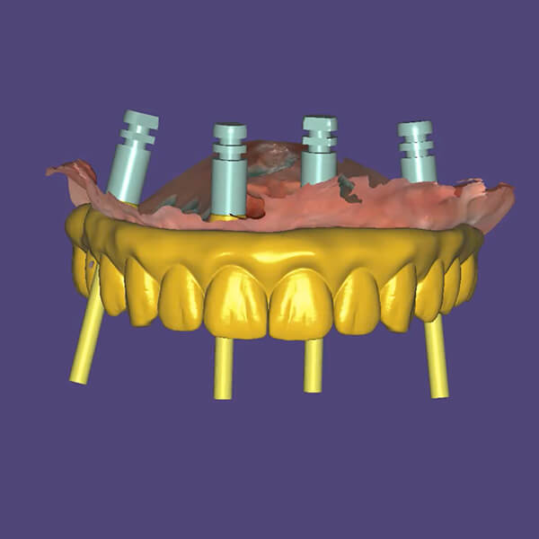 Restoring All on X Dental CE 2