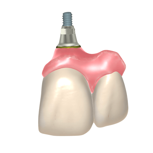exocad Design Image 2