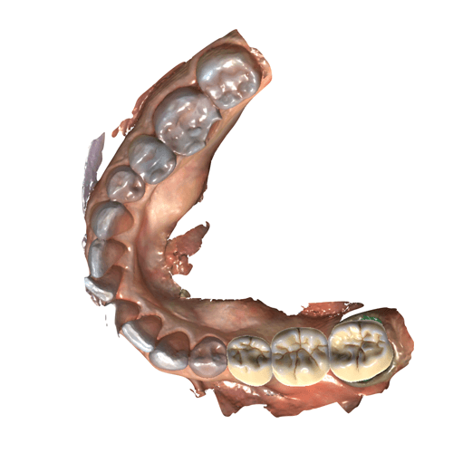 exocad Design Image 3