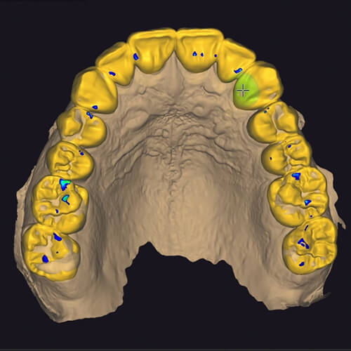 Advanced Occlusion exocad