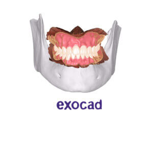 Advanced Occlusion Design in exocad CE Course MOD