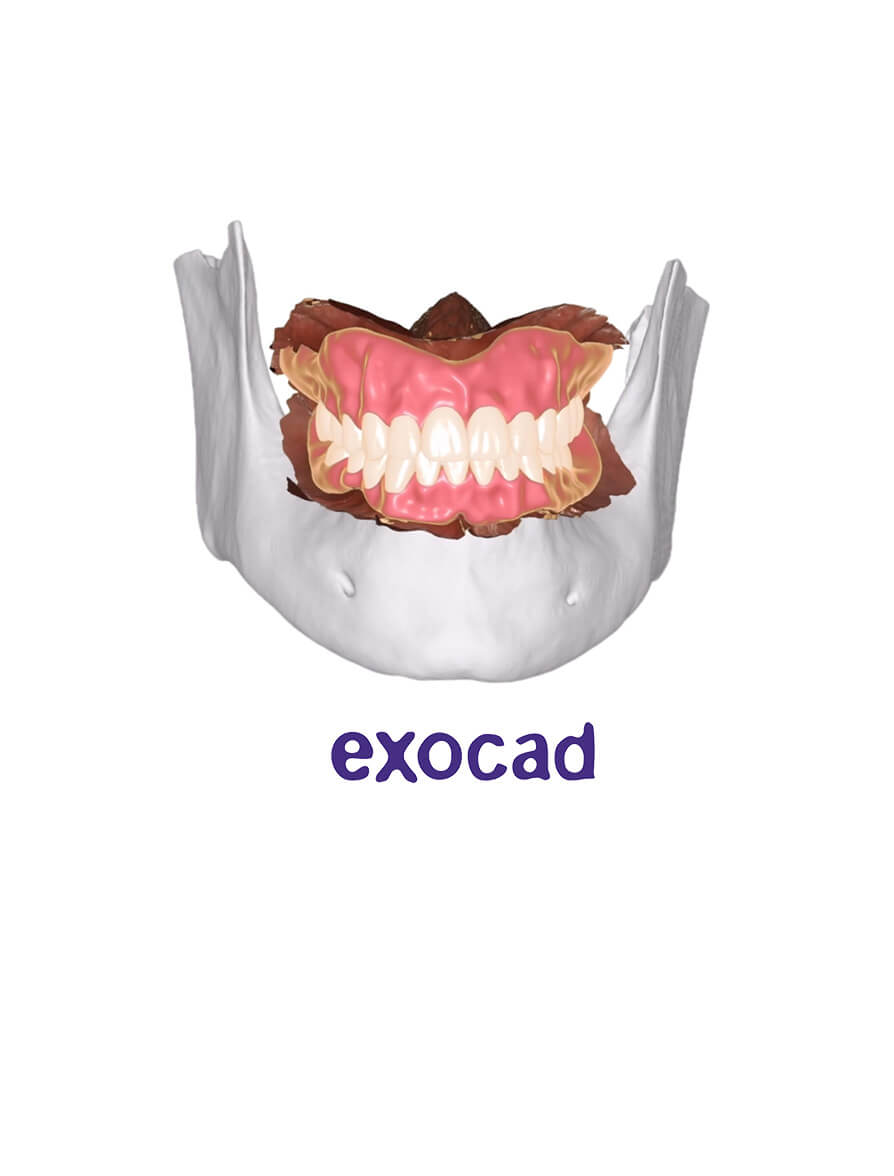 Advanced Occlusion Design in exocad CE Course MOD