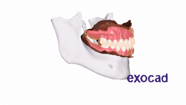 Advanced Occlusion Design in exocad CE Course