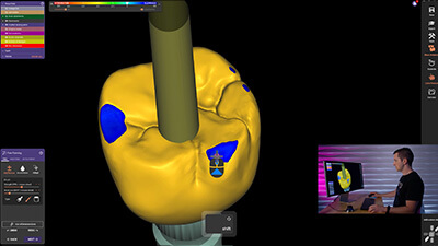 19. Posterior Implant- Cement Retained