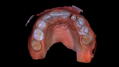 20.Anterior Implant Screw Retained