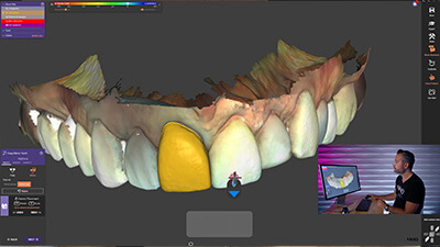 7. Anterior Crown CopyMirror