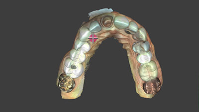 8. Anterior Crown PreOp