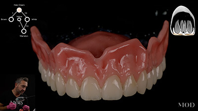 Split File Denture