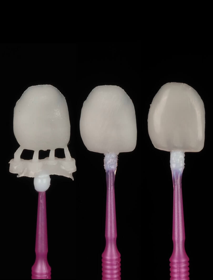 3D-Printed-Veneers-Product-Card