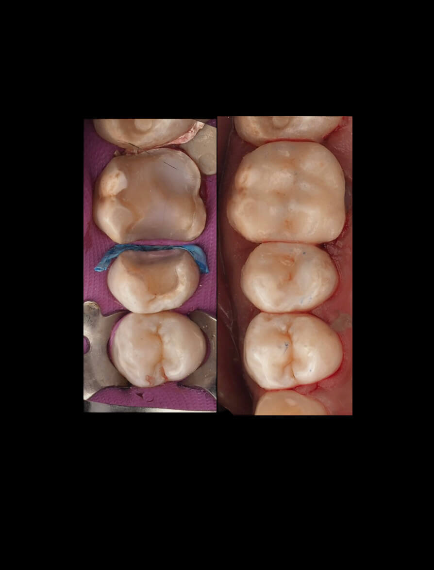 3D Printed Fillings CE Course Card