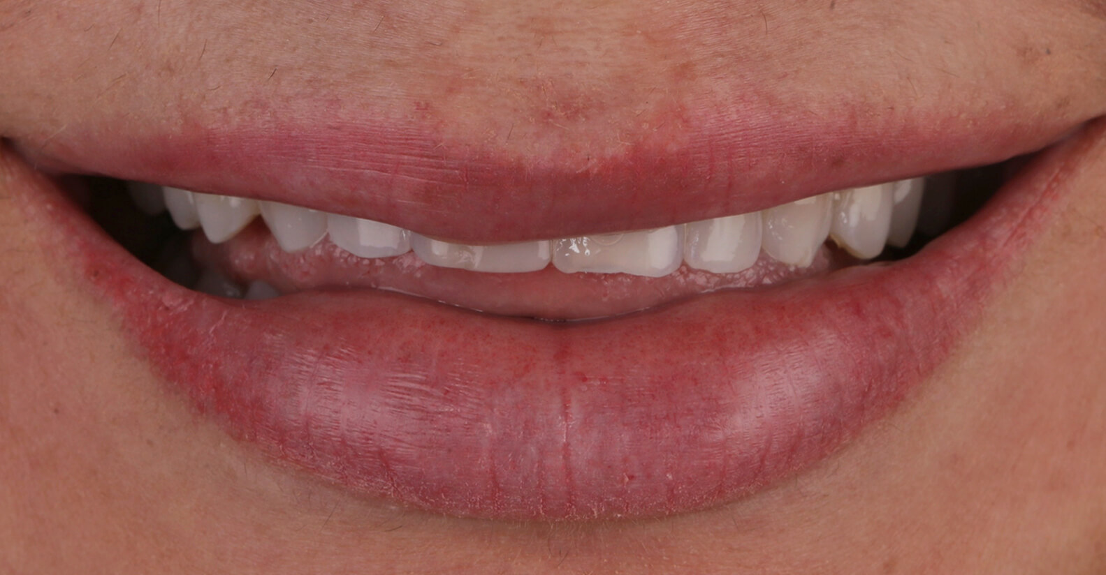 Veneer-After-3