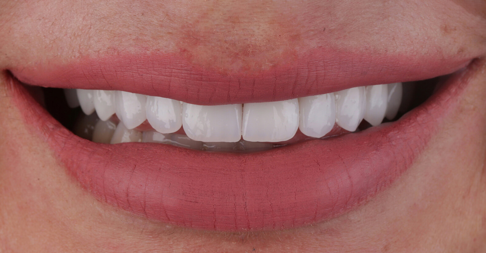 Veneers-After-3jpg