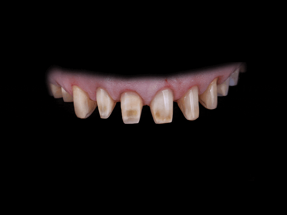 Full Mouth Procedure CE