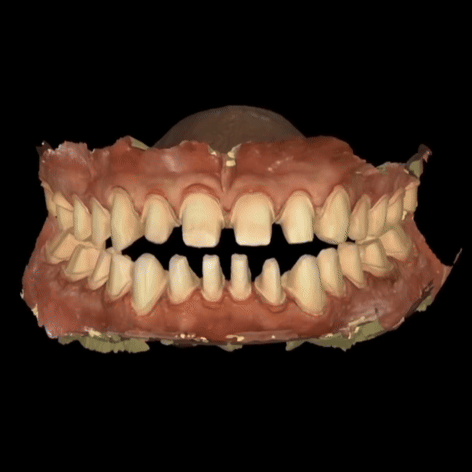 Full Mouth Restoration Dental CE