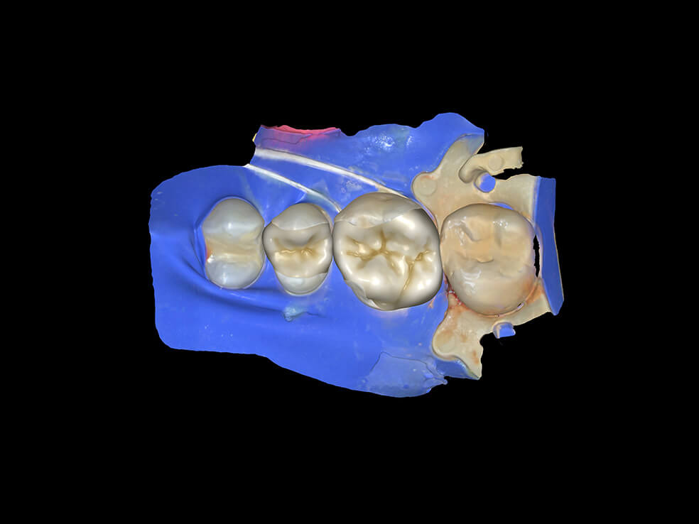 3D-Printed-Fillings-Day-2-Design