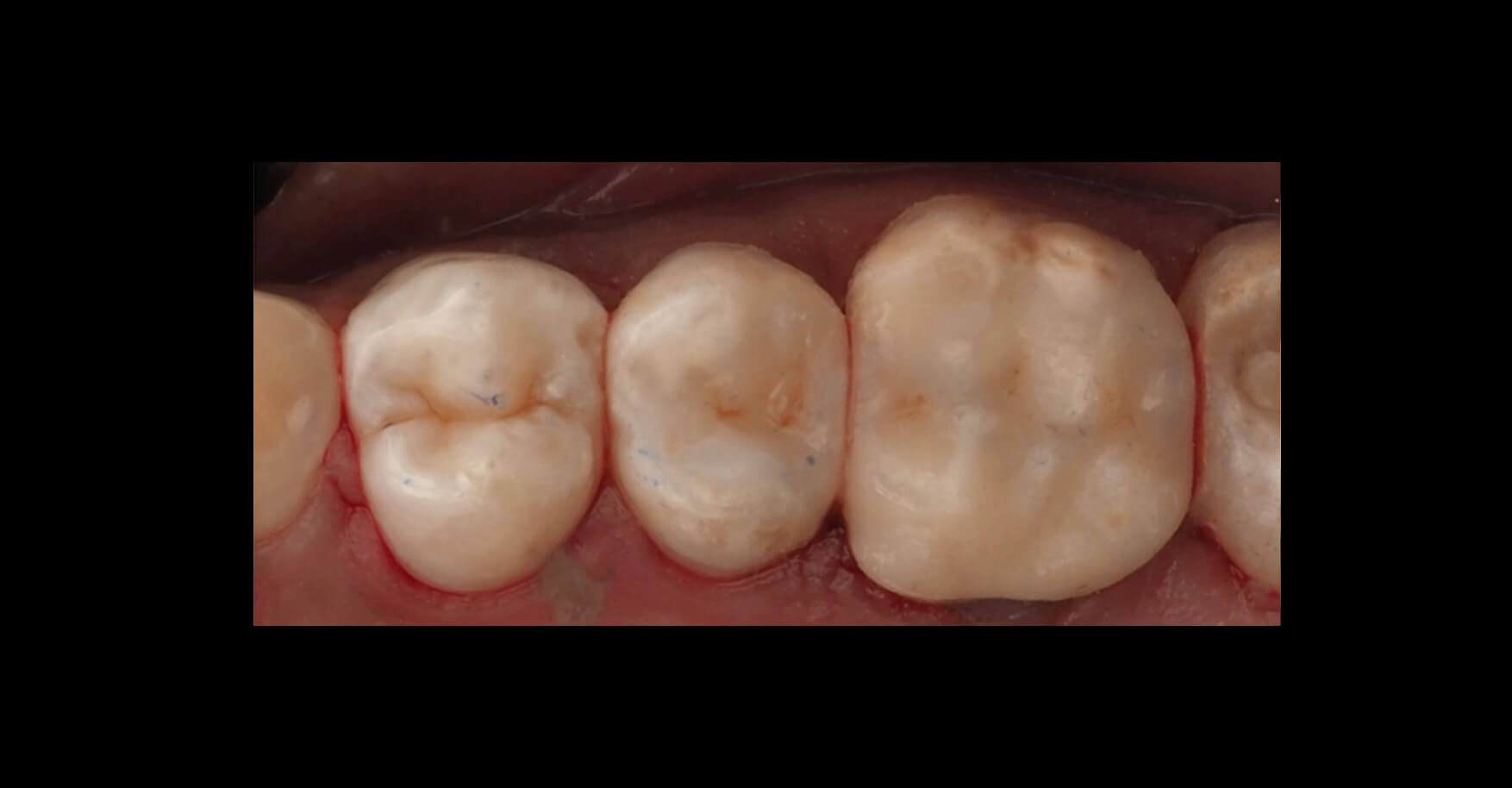 3D Printed Fillings Dental CE After