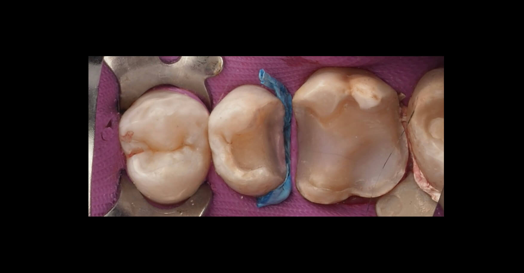 3D Printed Fillings Dental CE Before