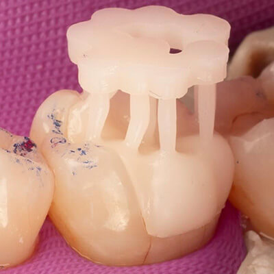 3D-Printed-Fillings-Residency-CE-1