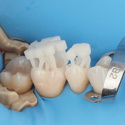 3D-Printed-Fillings-Residency-CE-2