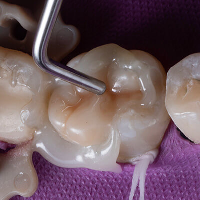 3D-Printed-Fillings-Residency-CE-3
