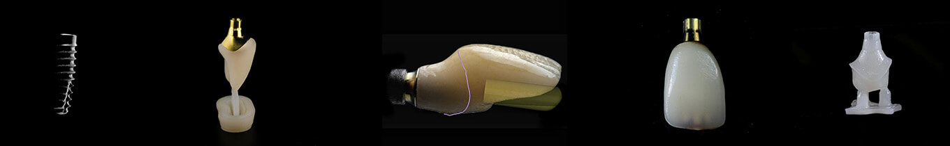 Implant Crowns Dental CE