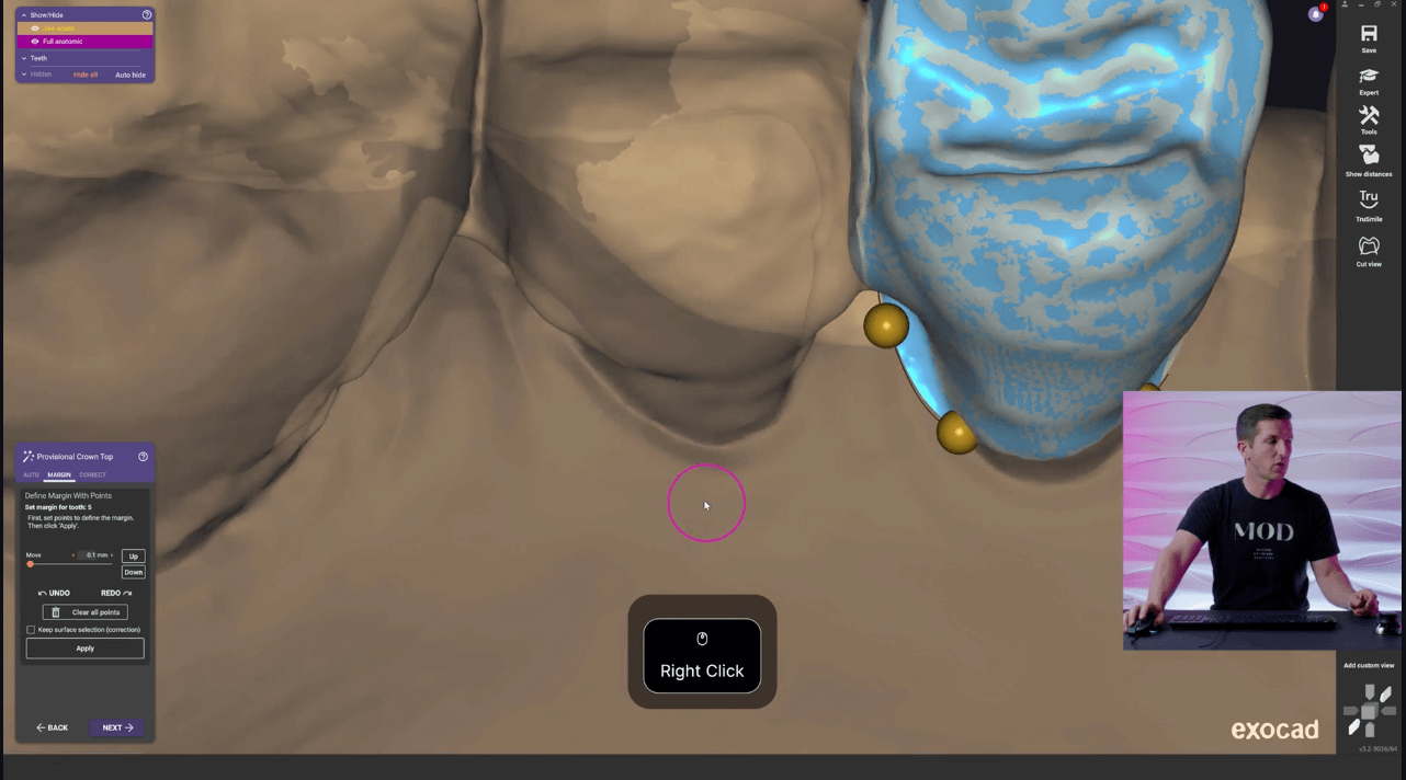 exocad level 12