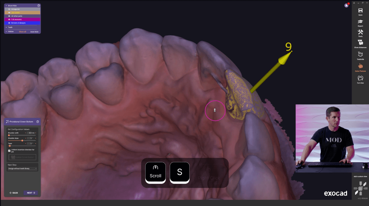 exocad level 13
