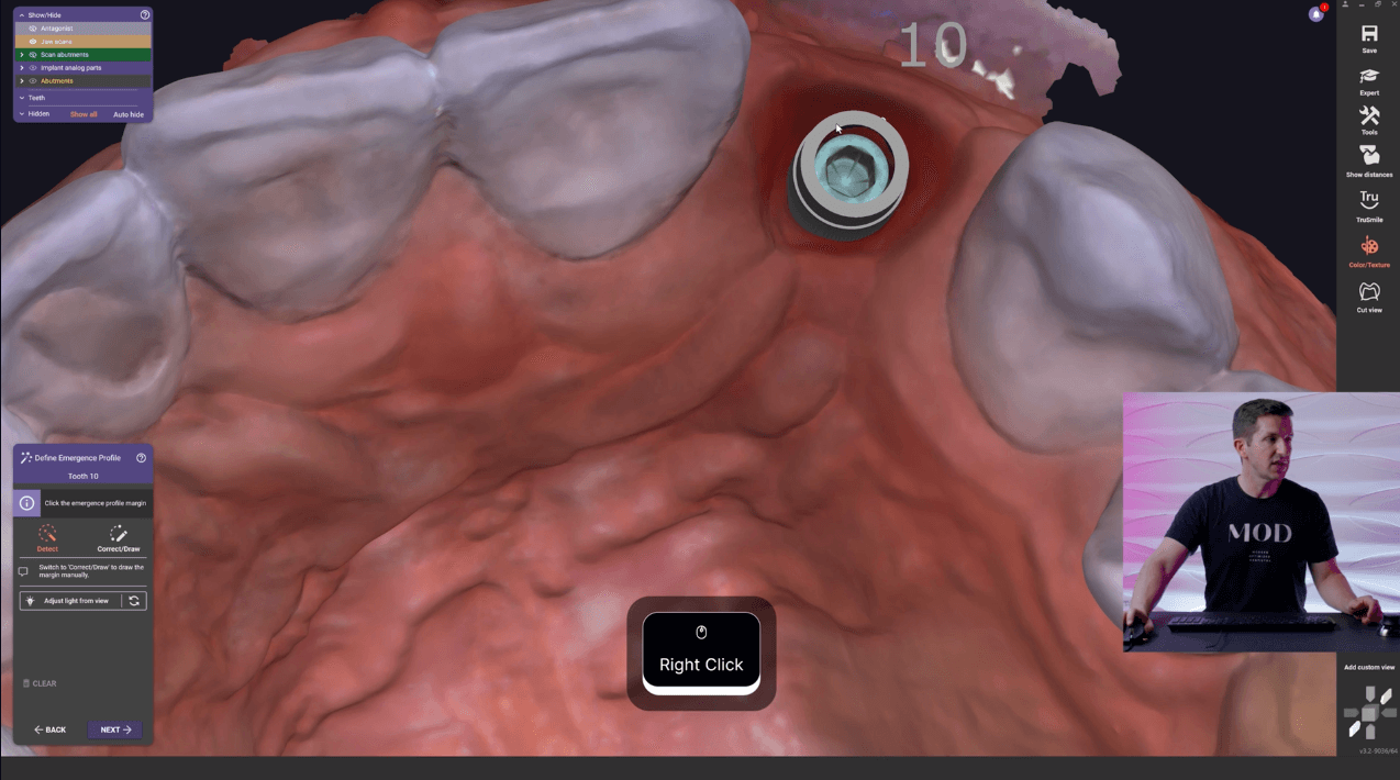 exocad level 15