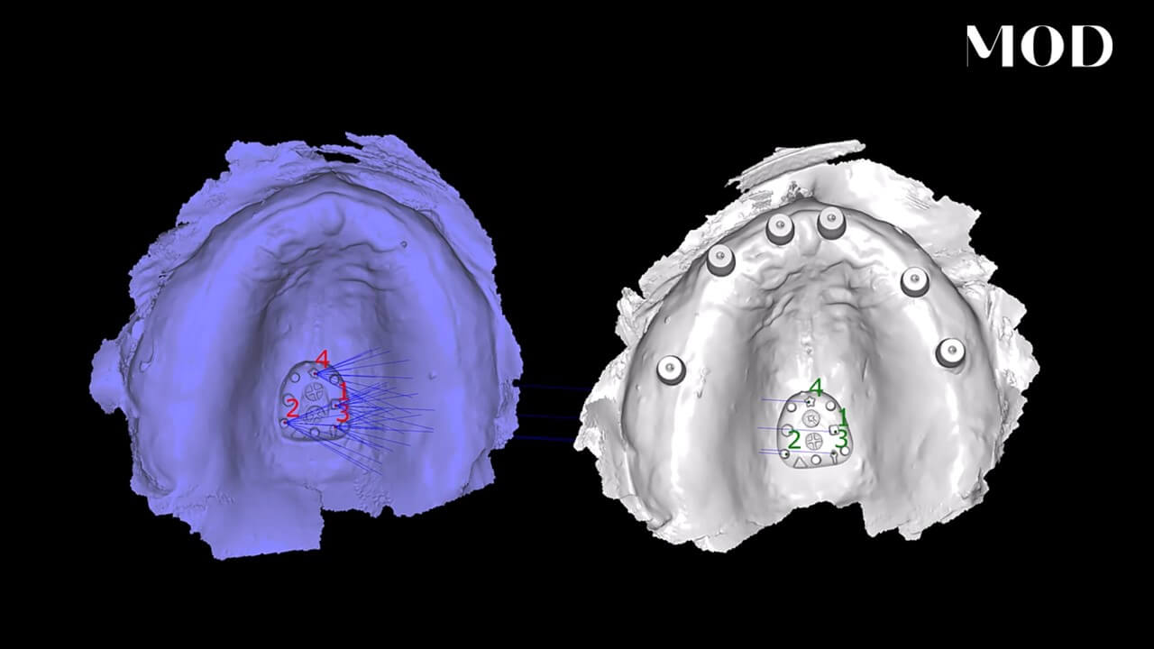 Align 3D Meshes with Tissue Tracker
