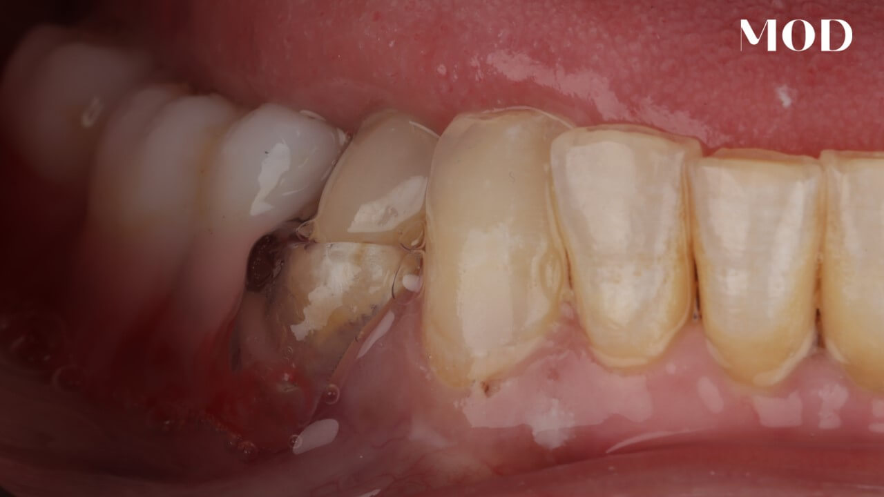 Deliver Partial Dentures