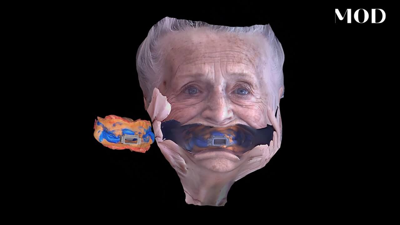 Face Scan for Edentulous Patients