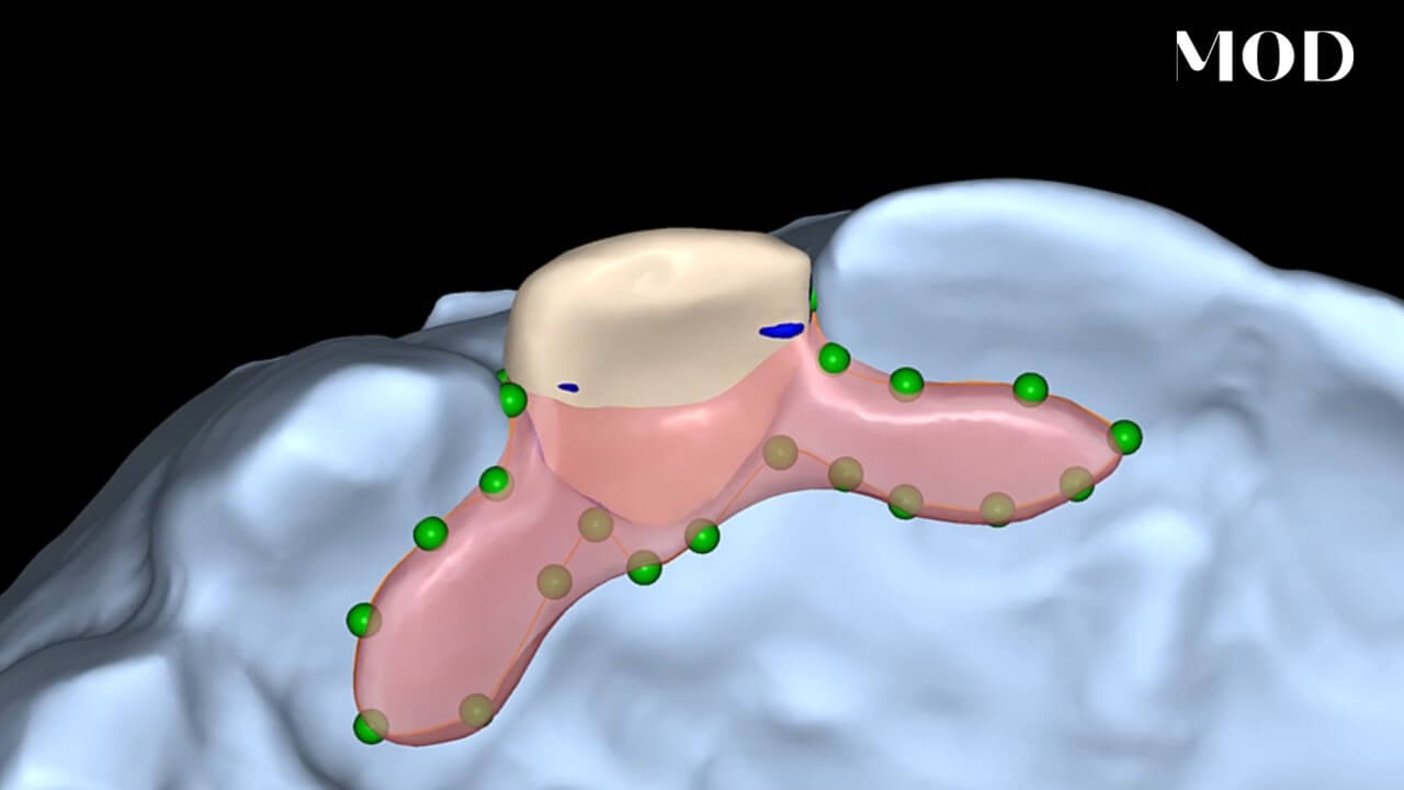 Immediate Maryland Bridge Design in exocad