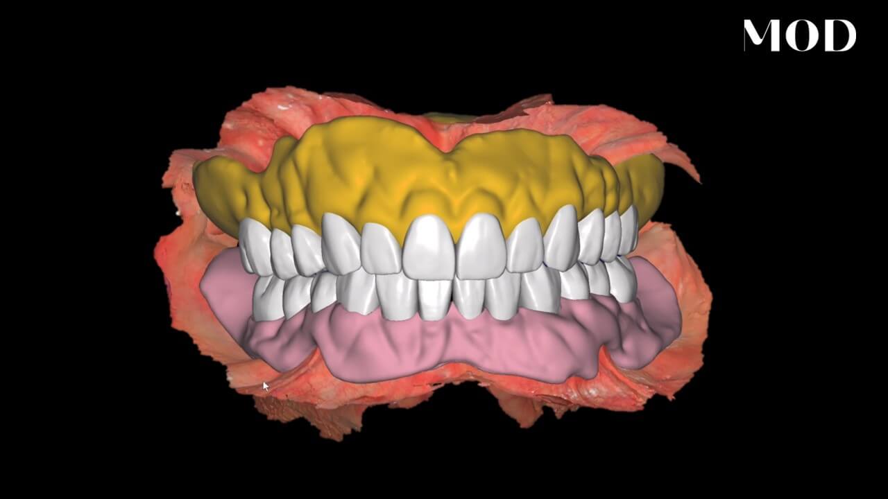 Same-Day Denture Case Overview