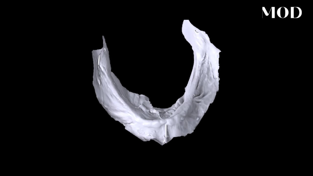 Scan Edentulous Arches